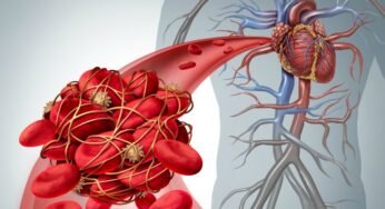 The HeartBreaking Truth Of Thrombosis